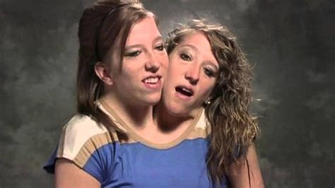 Abby And Brittany Hensel — See What The Famous Conjoined Twins Look