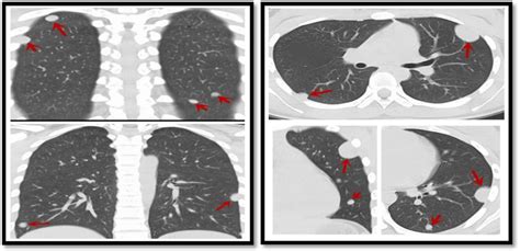 Chest Ct Multiple Spindle Cell Hemangiomas In Both Lungs Download