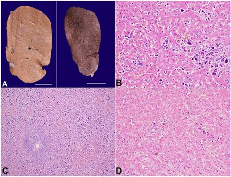 Scielo Brasil Autopsy Findings Of Acute Erythroid Leukemia Autopsy