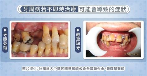 我有牙齦炎怎麼辦？如何清除牙菌斑？小心牙結石、牙周病接踵而來｜天下雜誌