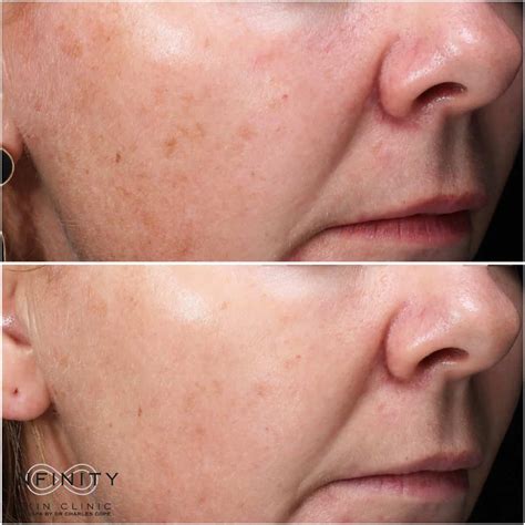 Skinpen Microneedling Before And After Images Infinity