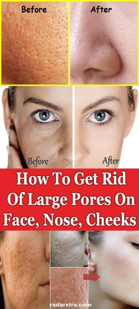 How To Get Rid Of Clogged Pores In 2020 With Images Nose Pores