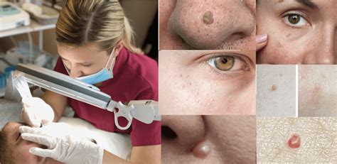 Removal Of Skin Lesions At Cheshire Lasers Clinic Middlewich