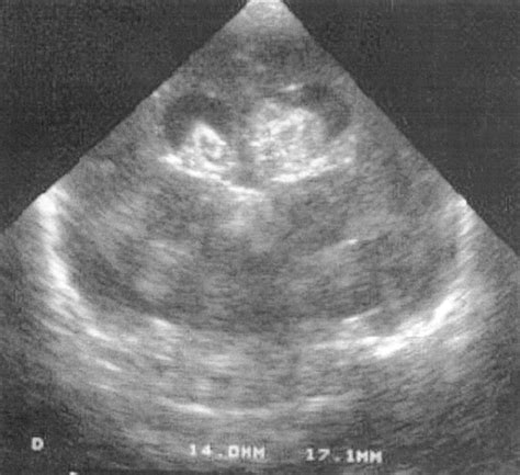 Posthaemorrhagic Ventricular Dilatation Adc Fetal And Neonatal Edition