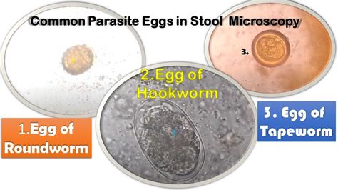 Roundworm Tapeworm And Hookworm Eggs In Stool Microscopy Youtube