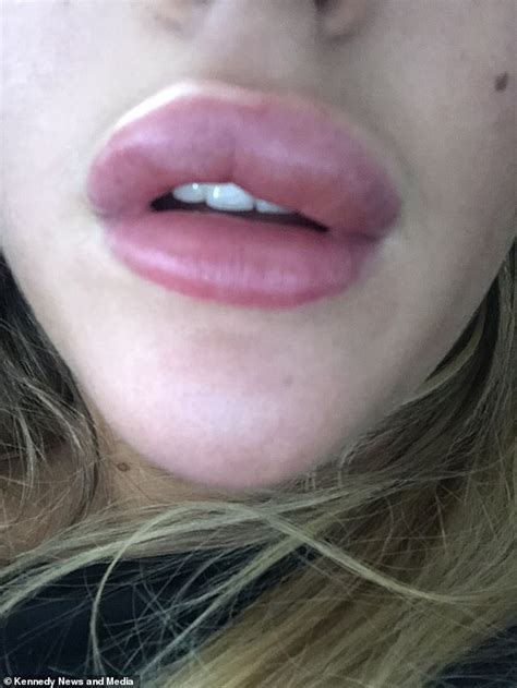 Flight Attendant 21 Claims That A £100 Filler Treatment Left Her Lips So Swollen Readsector