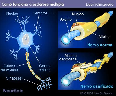 6,400 likes · 26 talking about this. Sistema Nervoso: Esclerose múltipla