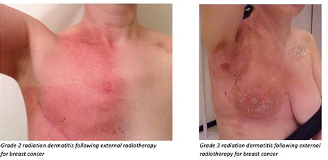 Breast cancer affects men and women. Radiation dermatitis - Repoceuticals