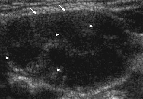 Sonographic Evaluation Of Cervical Lymph Nodes Ajr