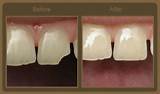 Small Chipped Tooth Repair Cost Photos