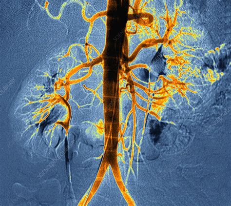 Kidney Blood Vessels Angiogram Stock Image C0337508 Science