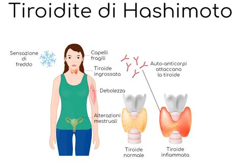Tiroidite Di Hashimoto Cause Sintomi Cura Valori Normali