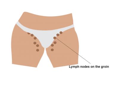 An inguinal hernia occurs when the intestines or fat from the abdomen bulge through the lower abdominal wall into the inguinal, or groin, area. Swollen Lymph Nodes in Neck, Groin, Armpit, Throat, under the Jaw, Chin.