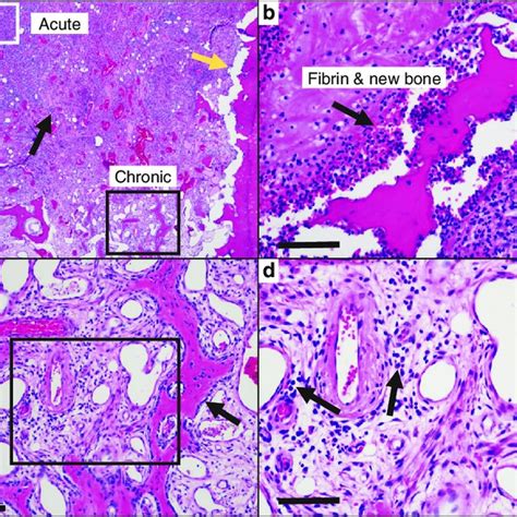 Histologic Features Of Acute And Chronic Osteomyelitis Exist In The