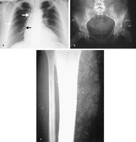 X Rays Showing Multiple Areas Of Round Shaped Calcifications In Soft