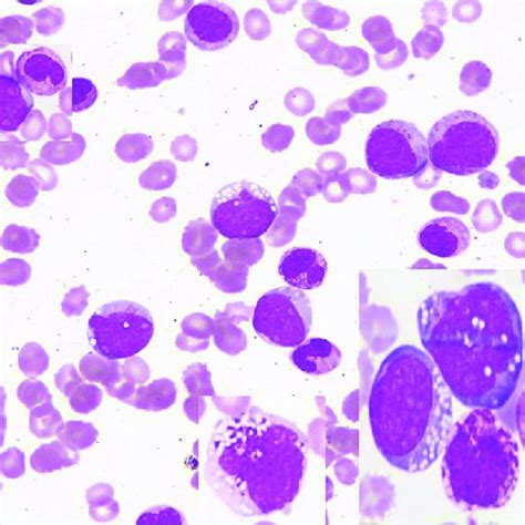 Peripheral Smear Shows Leukocytosis With Neutrophilia Eosinophilia
