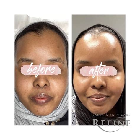 Before And Afters Refine Laser And Skin Care Chanhassen Minnetonka