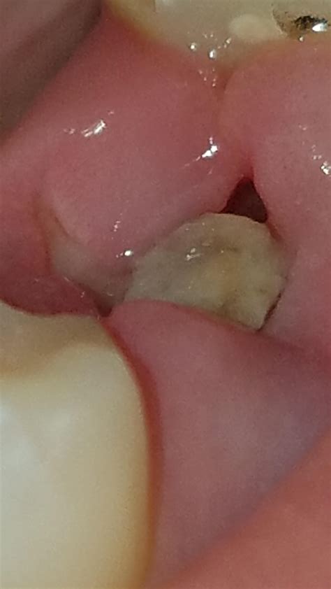 Tooth Extraction Site Need Advice R DentalAdvice