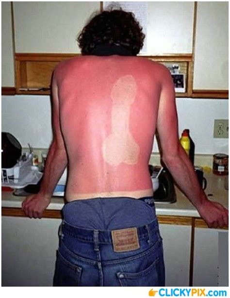 Sunburn Meme Gif