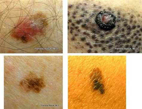 It is not the most common, but it is the most dangerous, because it spreads frequently. Melanoma - BASUK DERMATOLOGY