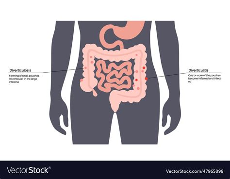 Diverticulitis And Diverticulosis Royalty Free Vector Image