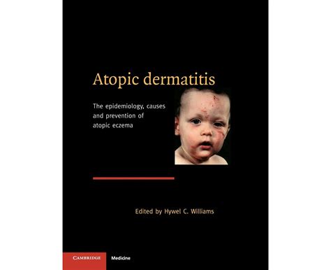 Atopic Dermatitis The Epidemiology Causes And Prevention Of Atopic