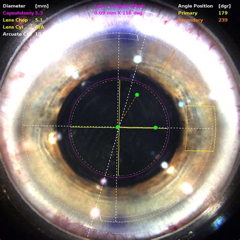 Rand Eye Institute Unveils High Def Custom Lensx® Laser Cataract Sx