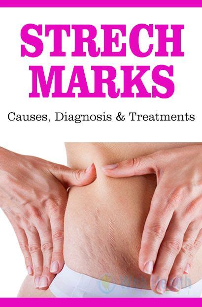 Stretch Marks Causes Diagnosis And Treatments Web Health Journal