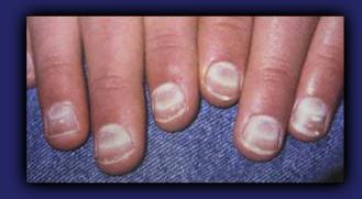 Maybe you would like to learn more about one of these? Oh, My Darn Nails: 6 Things Your Nails Are Trying to Tell ...