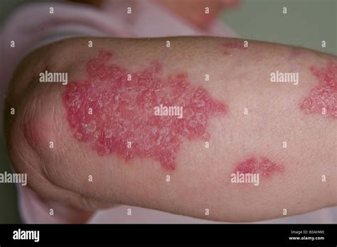 Psoriasis On Hi Res Stock Photography And Images Alamy