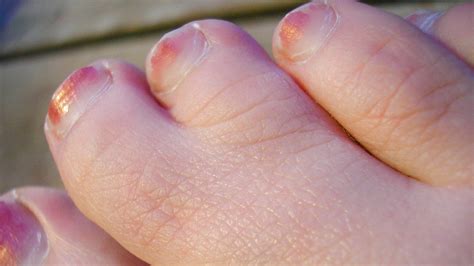 Webbed Toes Webbed Toes Human Males Foot Kind Stock Photo Edit Now Webbed Fingers