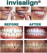 Photos of Insurance Cover Invisalign
