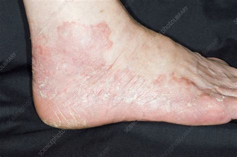 Eczema On The Foot Stock Image C0085604 Science Photo Library