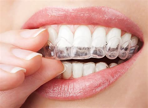 Advantages Of Invisible Orthodontics Dr Jamilian