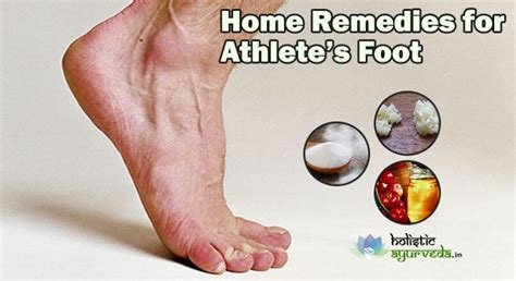 9 Home Remedies For Athletes Foot Cure With Natural Treatment