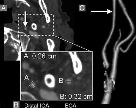 Diagnosing Carotid Stenosis Near Occlusion By Using Ct Angiography