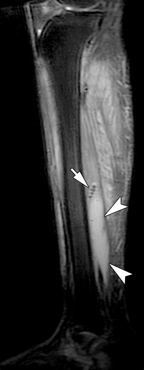 Soft Tissue Infections And Their Imaging Mimics From Cellulitis To