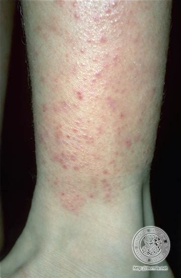 Skin Rash On Legs