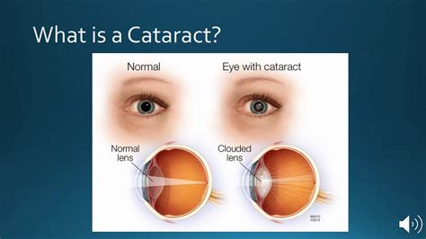 Understanding Cataract Surgery And Lens Options At Bochner Eye In Toronto Youtube