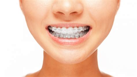 Adult Orthodontic Services Great Lakes Dental