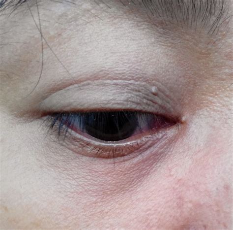 Dee-lighted!!! : Syringoma and MiliaTreatment RCC Amazing ...