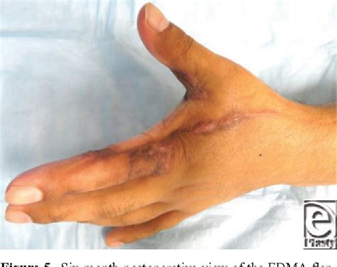 Electrical Burns Hand