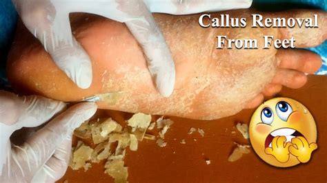 Callus Removal From Feet＃11 Youtube
