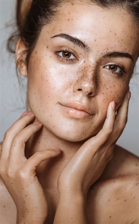 Women With Freckles Freckles Girl Beautiful Freckles Forehead