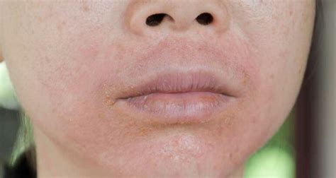 Treatment Methods For Lupus Skin Rashes Browsing