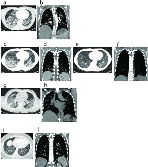 Ct Scans Computerized Tomography Of Chest Showing A Spectrum Of Evali