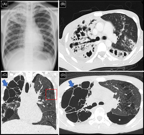 Cystic Lung Disease As A Complication Of Post‐tuberculosis Infection In