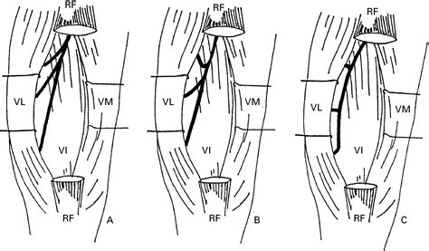 Mononeuropathy Of A Distal Branch Of The Femoral Nerve In A Body