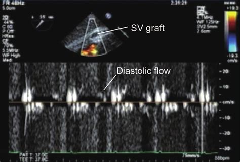 Transesophageal Echocardiogram Showing Markedly Reduced Diastolic Flow