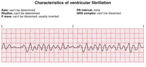 Ventricular Fibrillation Vf Diagram Quizlet
